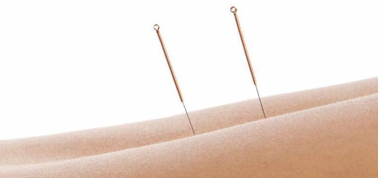 3 usos de la acupuntura 3 usos de la acupuntura